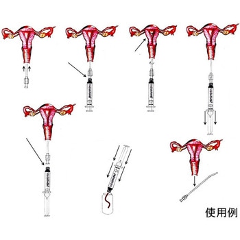 子宮体癌組織診用採取器具 エンドサンプラー 25本入 MedGyn Products