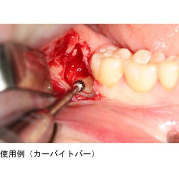 サージェリータングステンカーバイトバー RA エクストラストロング 2本入 HFシリーズ マイクロテック